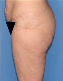 Thigh Lift Before Photo by Siamak Agha, MD PhD FACS; Newport Beach, CA - Case 44534