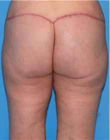 Thigh Lift After Photo by Siamak Agha, MD PhD FACS; Newport Beach, CA - Case 44534