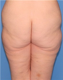 Thigh Lift Before Photo by Siamak Agha, MD PhD FACS; Newport Beach, CA - Case 44534