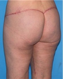 Thigh Lift After Photo by Siamak Agha, MD PhD FACS; Newport Beach, CA - Case 44534