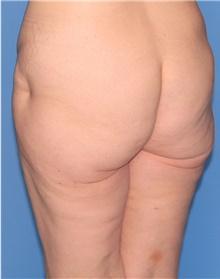 Thigh Lift Before Photo by Siamak Agha, MD PhD FACS; Newport Beach, CA - Case 44534