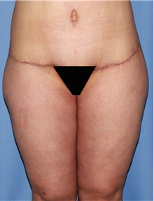 Thigh Lift After Photo by Siamak Agha, MD PhD FACS; Newport Beach, CA - Case 44535