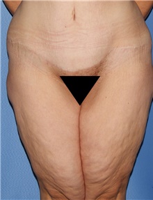 Thigh Lift Before Photo by Siamak Agha, MD PhD FACS; Newport Beach, CA - Case 44535