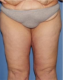 Thigh Lift After Photo by Siamak Agha, MD PhD FACS; Newport Beach, CA - Case 44536