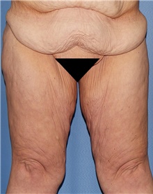 Thigh Lift Before Photo by Siamak Agha, MD PhD FACS; Newport Beach, CA - Case 44536