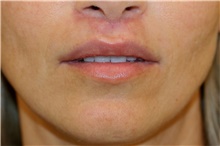 Lip Augmentation/Enhancement After Photo by Steve Laverson, MD, FACS; Rancho Santa Fe, CA - Case 44552