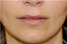 Lip Augmentation/Enhancement Before Photo by Steve Laverson, MD, FACS; Rancho Santa Fe, CA - Case 44552