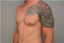 Male Breast Reduction After Photo by Carlos Rivera-Serrano, MD; Bay Harbour Islands, FL - Case 44599