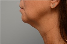 Chin Augmentation Before Photo by Carlos Rivera-Serrano, MD; Bay Harbour Islands, FL - Case 44615