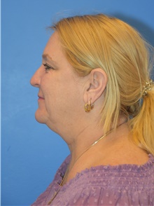 Facelift Before Photo by Adam Weinfeld, MD; Austin, TX - Case 44628