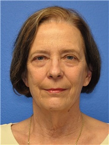 Facelift Before Photo by Adam Weinfeld, MD; Austin, TX - Case 44639