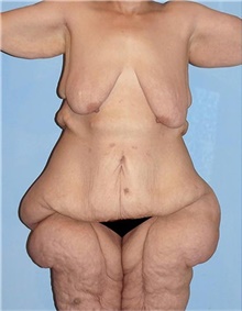 Body Lift Before Photo by Siamak Agha, MD PhD FACS; Newport Beach, CA - Case 44691