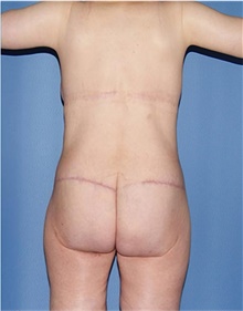 Body Lift After Photo by Siamak Agha, MD PhD FACS; Newport Beach, CA - Case 44691