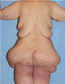 Body Lift Before Photo by Siamak Agha, MD PhD FACS; Newport Beach, CA - Case 44691