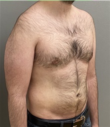 Male Breast Reduction After Photo by Keshav Magge, MD; Bethesda, MD - Case 44704