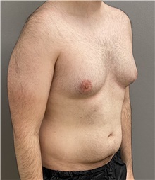 Male Breast Reduction Before Photo by Keshav Magge, MD; Bethesda, MD - Case 44704