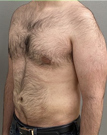 Male Breast Reduction After Photo by Keshav Magge, MD; Bethesda, MD - Case 44704