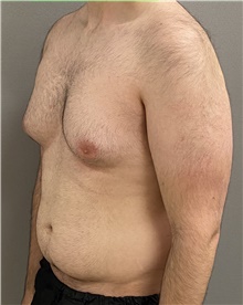 Male Breast Reduction Before Photo by Keshav Magge, MD; Bethesda, MD - Case 44704