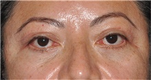 Eyelid Surgery After Photo by Jerry Weiger Chang, MD, FACS; Flushing, NY - Case 44895