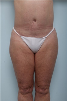 Body Contouring After Photo by Paul Vitenas, Jr., MD; Houston, TX - Case 44899