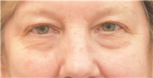 Eyelid Surgery Before Photo by Keshav Magge, MD; Bethesda, MD - Case 44930