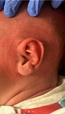 Ear Surgery After Photo by Rachel Ruotolo, MD; Garden City, NY - Case 44950