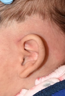 Ear Surgery Before Photo by Rachel Ruotolo, MD; Garden City, NY - Case 44957