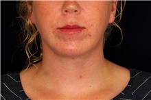 Chin Augmentation After Photo by Landon Pryor, MD, FACS; Rockford, IL - Case 45030