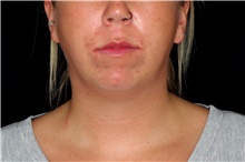 Chin Augmentation Before Photo by Landon Pryor, MD, FACS; Rockford, IL - Case 45030