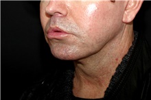 Lip Augmentation/Enhancement After Photo by Landon Pryor, MD, FACS; Rockford, IL - Case 45050