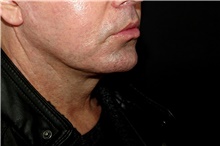 Lip Augmentation/Enhancement After Photo by Landon Pryor, MD, FACS; Rockford, IL - Case 45050