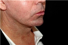 Lip Augmentation/Enhancement Before Photo by Landon Pryor, MD, FACS; Rockford, IL - Case 45050