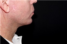 Lip Augmentation/Enhancement Before Photo by Landon Pryor, MD, FACS; Rockford, IL - Case 45050