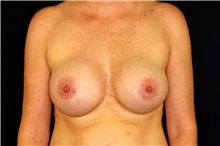 Breast Augmentation After Photo by Landon Pryor, MD, FACS; Rockford, IL - Case 45090