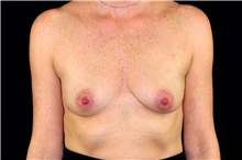 Breast Augmentation Before Photo by Landon Pryor, MD, FACS; Rockford, IL - Case 45090