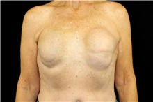 Breast Implant Removal Before Photo by Landon Pryor, MD, FACS; Rockford, IL - Case 45152