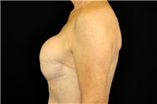 Breast Implant Removal Before Photo by Landon Pryor, MD, FACS; Rockford, IL - Case 45152