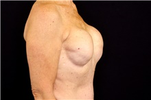 Breast Implant Removal Before Photo by Landon Pryor, MD, FACS; Rockford, IL - Case 45152