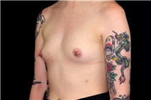 Breast Augmentation Before Photo by Landon Pryor, MD, FACS; Rockford, IL - Case 45170