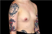 Breast Augmentation Before Photo by Landon Pryor, MD, FACS; Rockford, IL - Case 45170