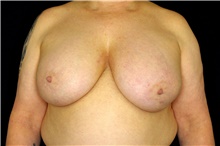 Breast Implant Removal Before Photo by Landon Pryor, MD, FACS; Rockford, IL - Case 45181