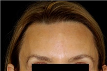 Hair Transplant After Photo by Landon Pryor, MD, FACS; Rockford, IL - Case 45182