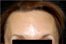 Hair Transplant Before Photo by Landon Pryor, MD, FACS; Rockford, IL - Case 45182