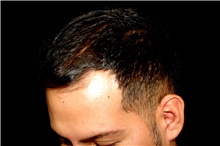 Hair Transplant Before Photo by Landon Pryor, MD, FACS; Rockford, IL - Case 45183