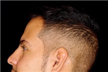 Hair Transplant After Photo by Landon Pryor, MD, FACS; Rockford, IL - Case 45183