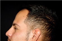 Hair Transplant Before Photo by Landon Pryor, MD, FACS; Rockford, IL - Case 45183