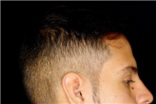 Hair Transplant After Photo by Landon Pryor, MD, FACS; Rockford, IL - Case 45183