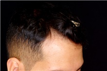 Hair Transplant After Photo by Landon Pryor, MD, FACS; Rockford, IL - Case 45183