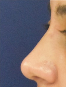 Rhinoplasty After Photo by Richard Reish, MD, FACS; New York, NY - Case 45285