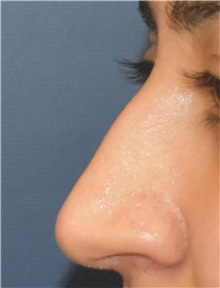 Rhinoplasty Before Photo by Richard Reish, MD, FACS; New York, NY - Case 45285